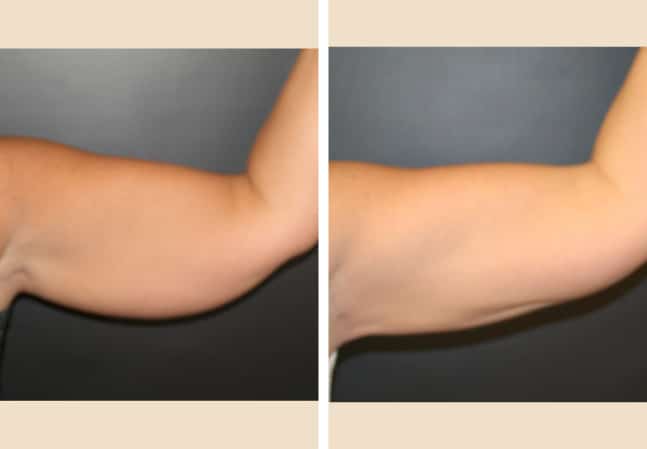 brachioplasty