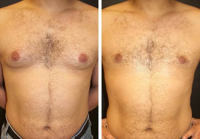 breast male photo reduction Sex and urination
