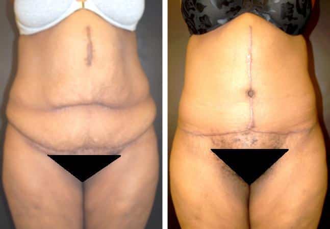 Tummy Tuck Before And After Photo