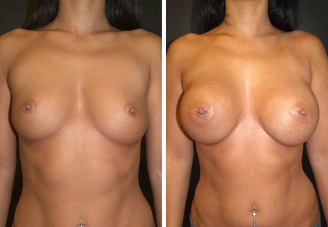 breast augmentation p03 front lg 1