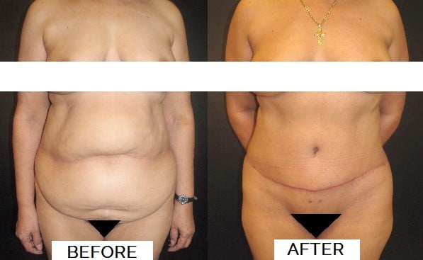 abdominoplasty