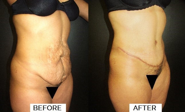 abdominoplasty2