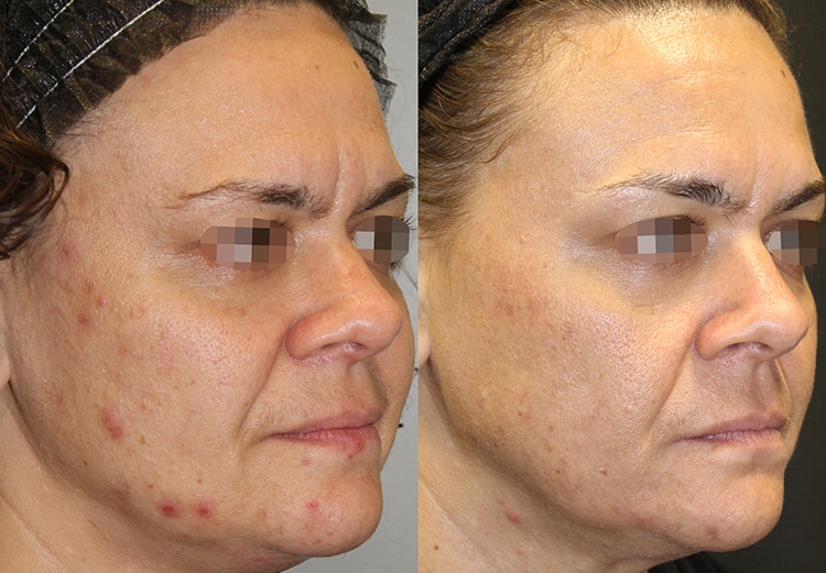 Alma Hybrid Laser Treatment Before & After New York NY
