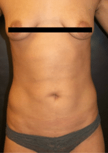 After Image: Liposuction – Abdomen