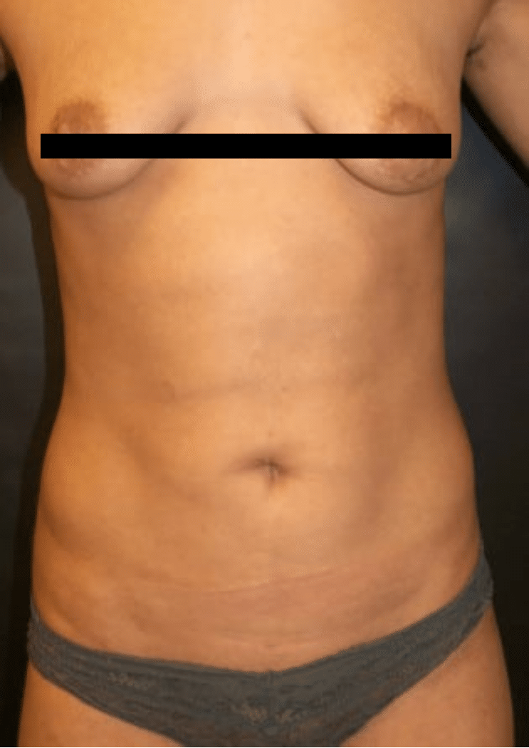 After Image: Liposuction – Abdomen - front