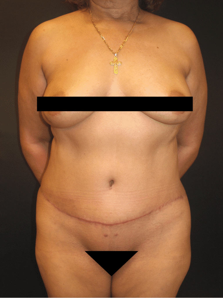 After Image: Abdominoplasty - front