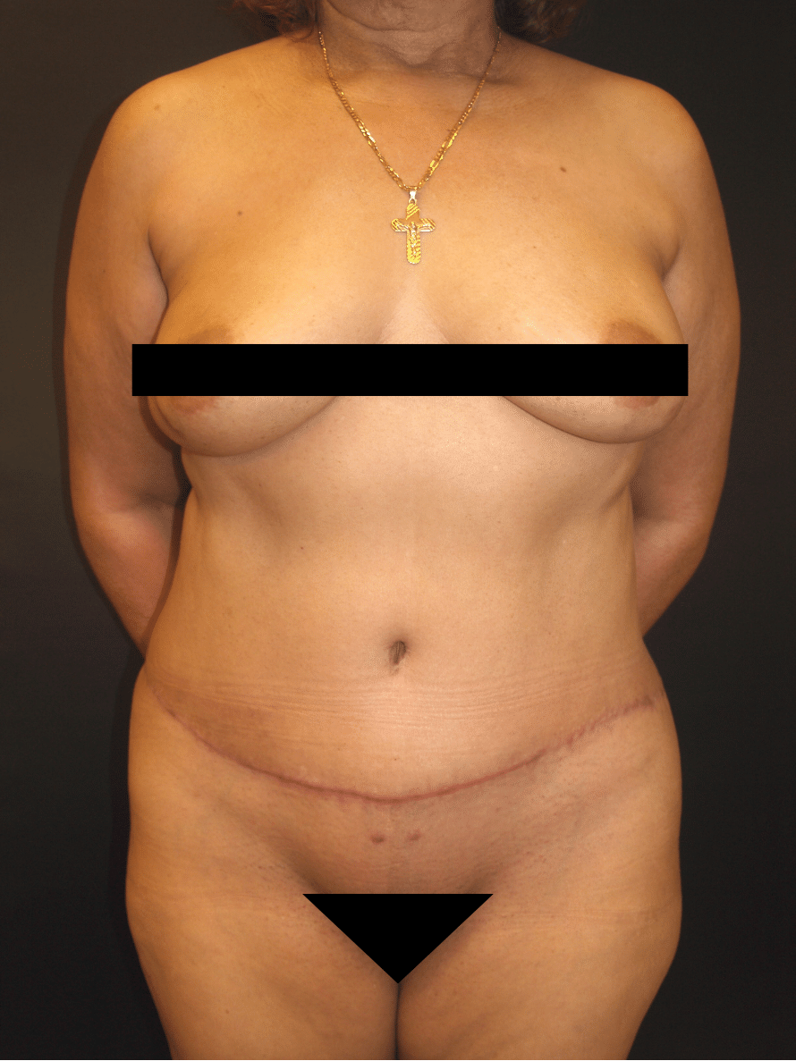 After Image: Abdominoplasty - front