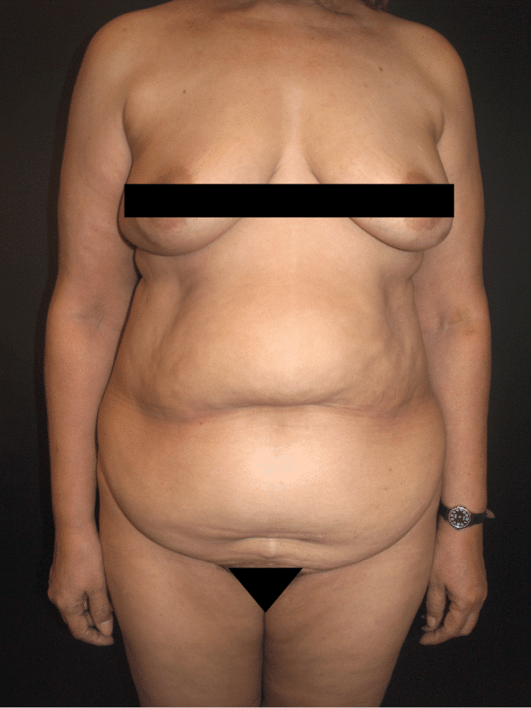 Before Image: Abdominoplasty - front