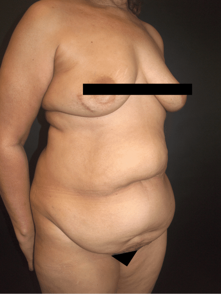 Before Image: Abdominoplasty - right-front-oblique
