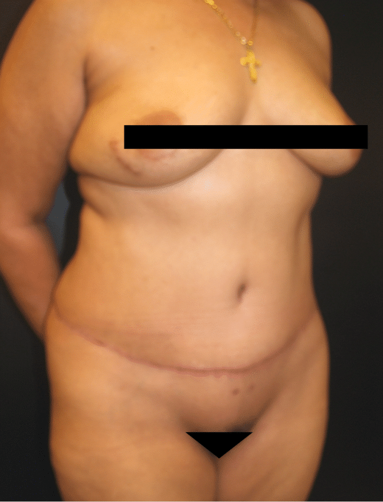After Image: Abdominoplasty - right-front-oblique