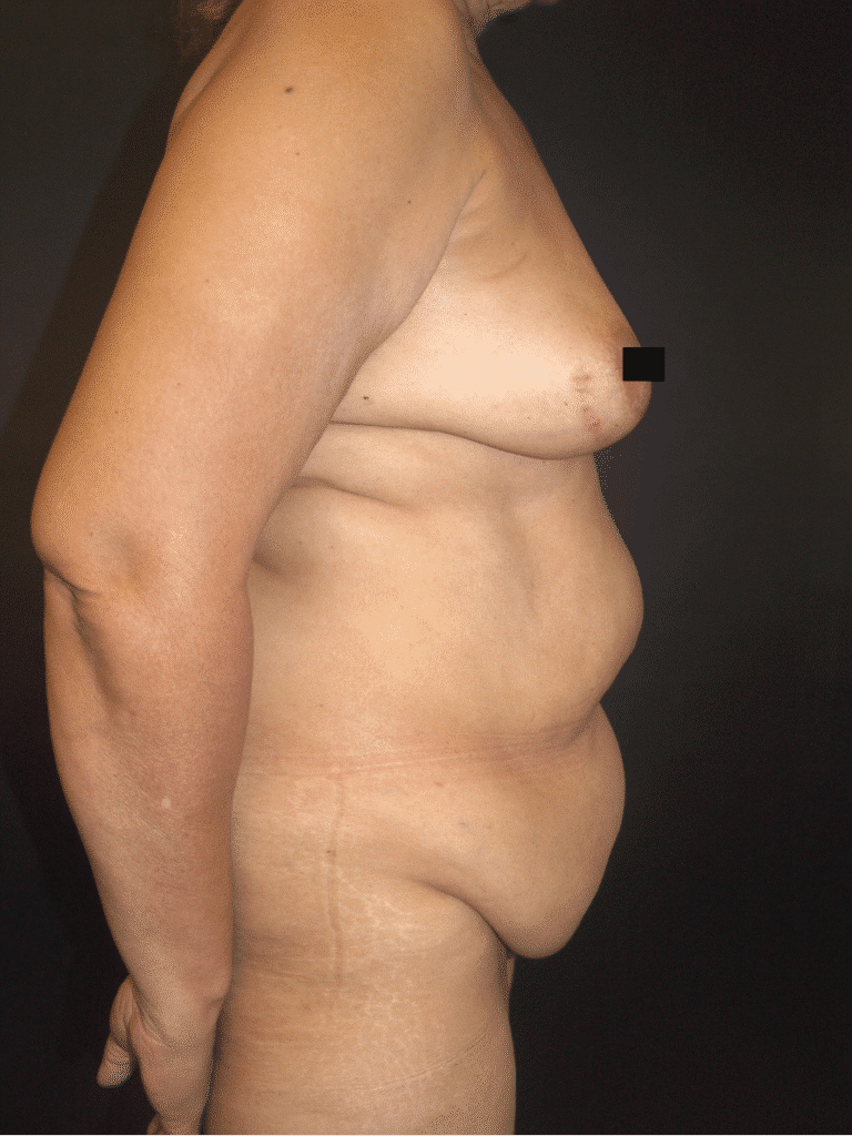 Before Image: Abdominoplasty - right-side
