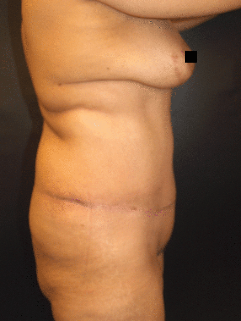 After Image: Abdominoplasty - right-side