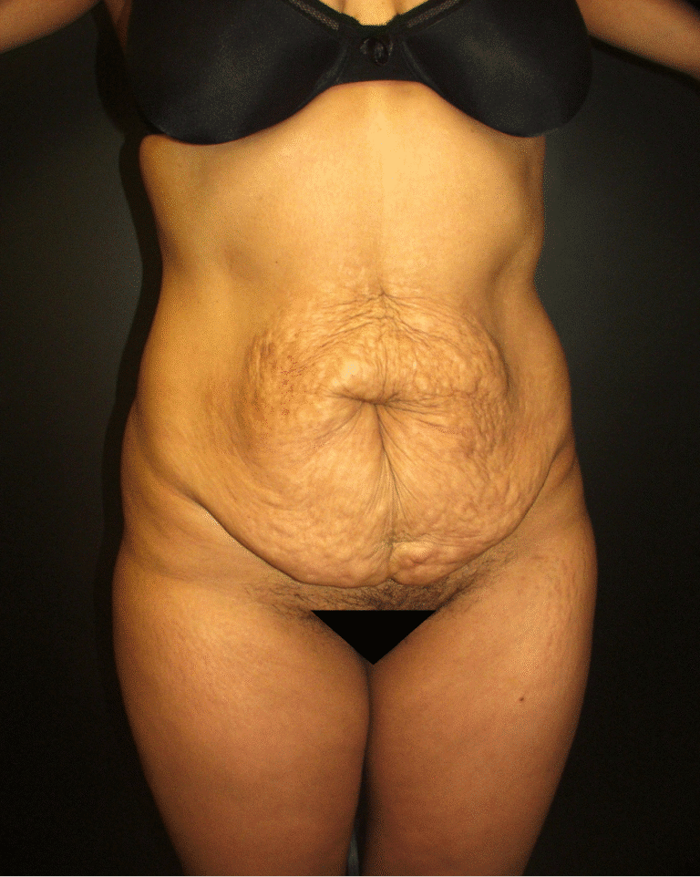 Before Image: Abdominoplasty - front