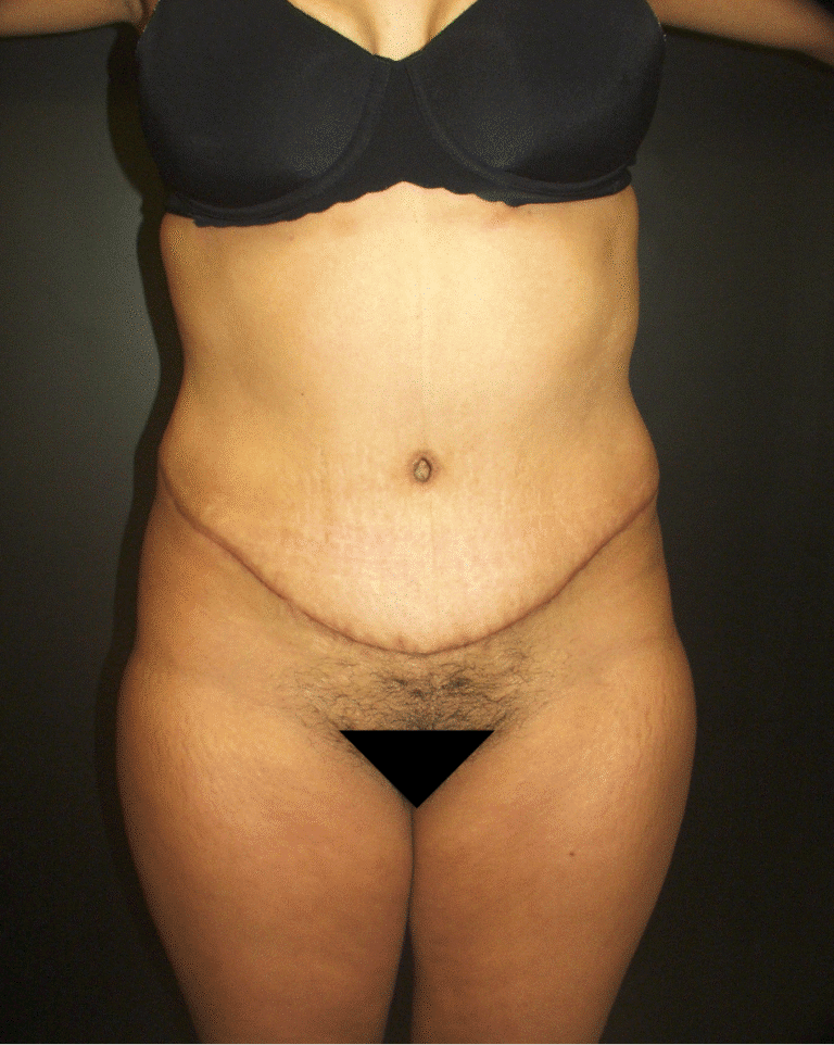 After Image: Abdominoplasty - front