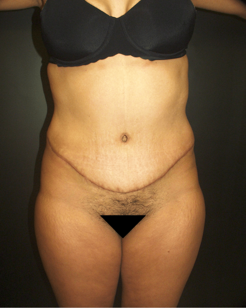 After Image: Abdominoplasty - front