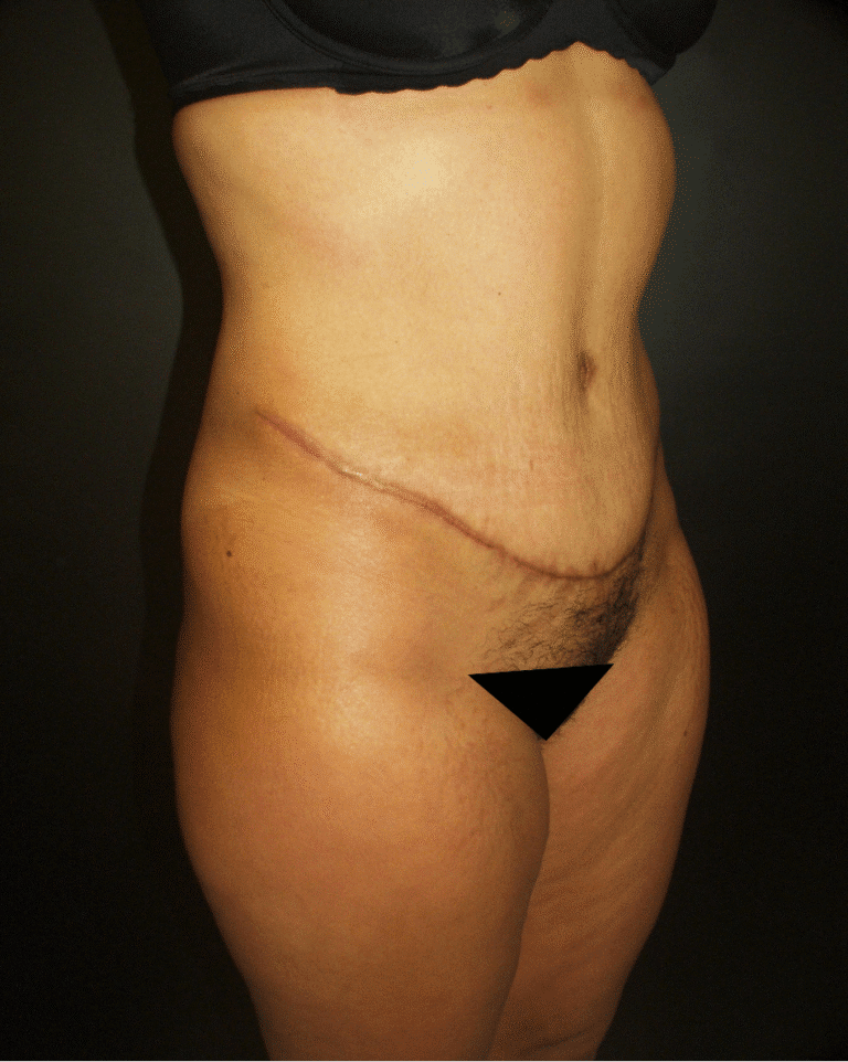 After Image: Abdominoplasty - right-front-oblique