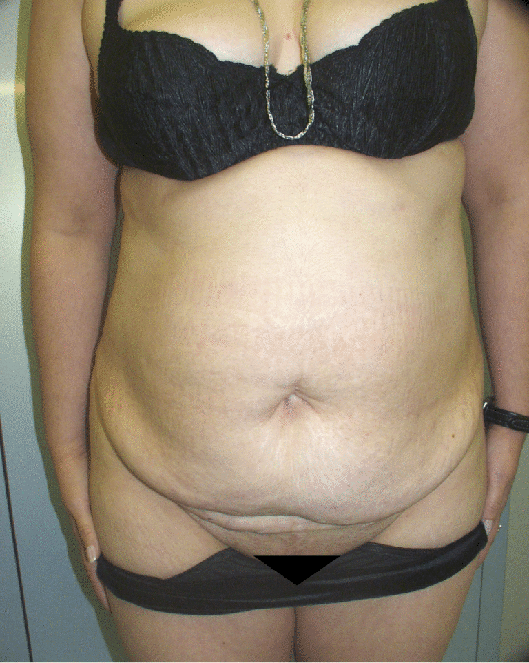 Before Image: Abdominoplasty - front