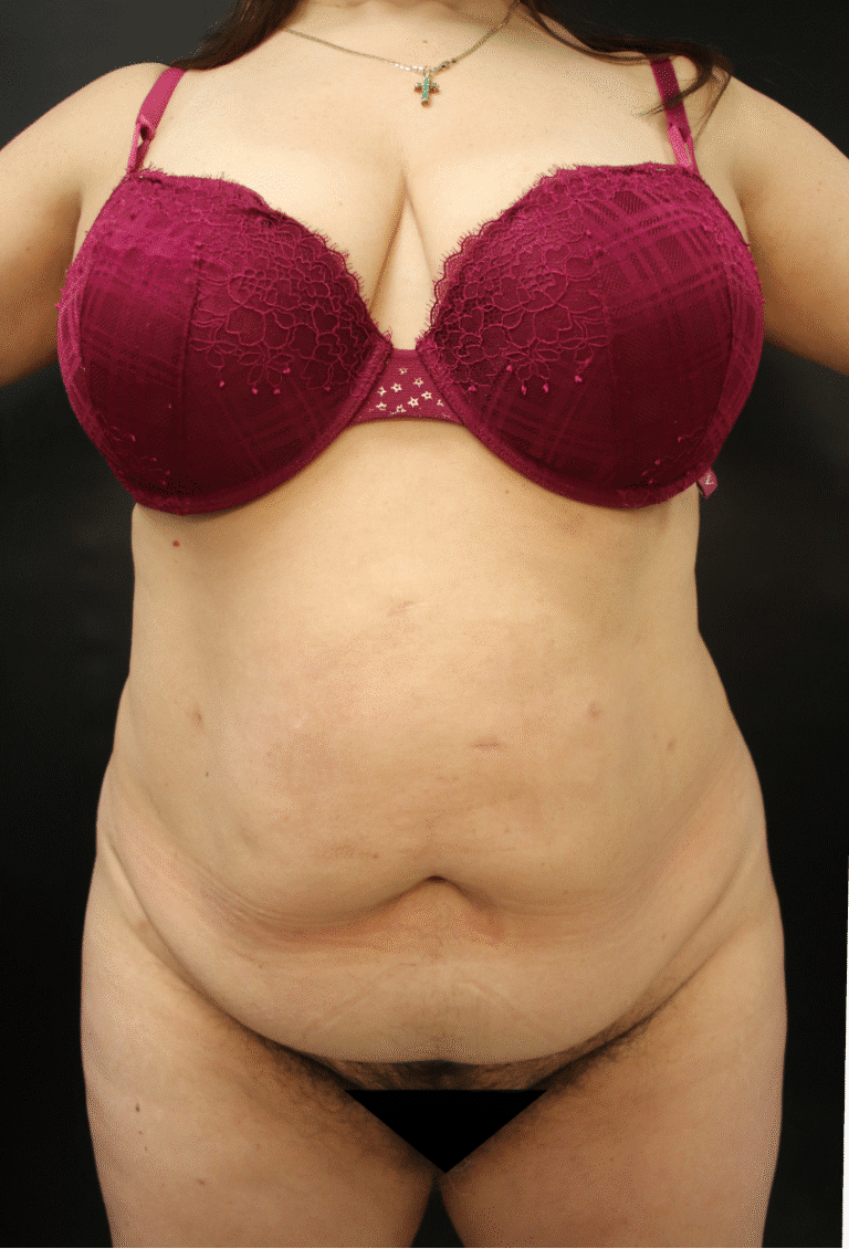 Before Image: Abdominoplasty - front