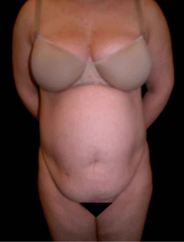 Before Image: Abdominoplasty - front