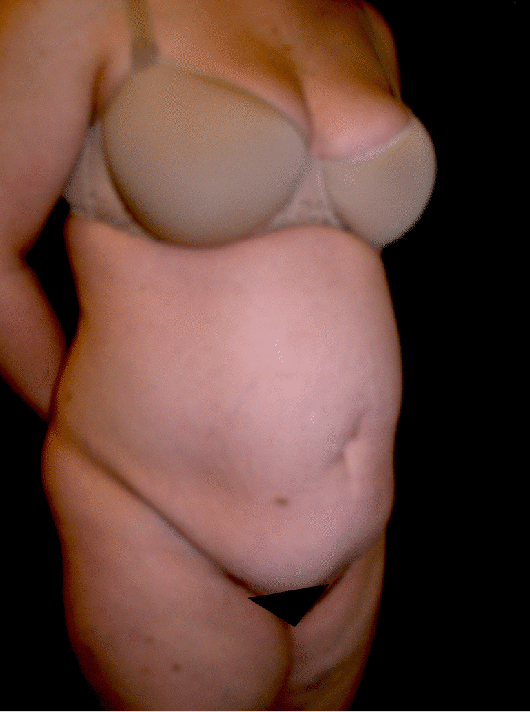 Before Image: Abdominoplasty - right-front-oblique