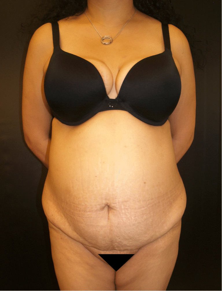 Before Image: Abdominoplasty - front