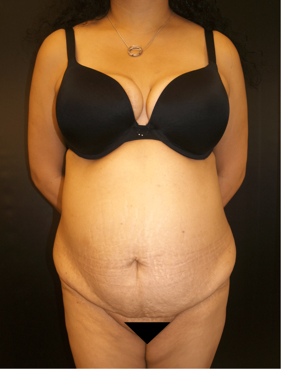 Before Image: Abdominoplasty - front