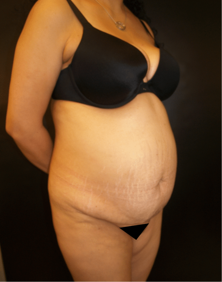 Before Image: Abdominoplasty - right-front-oblique