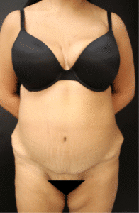After Image: Abdominoplasty