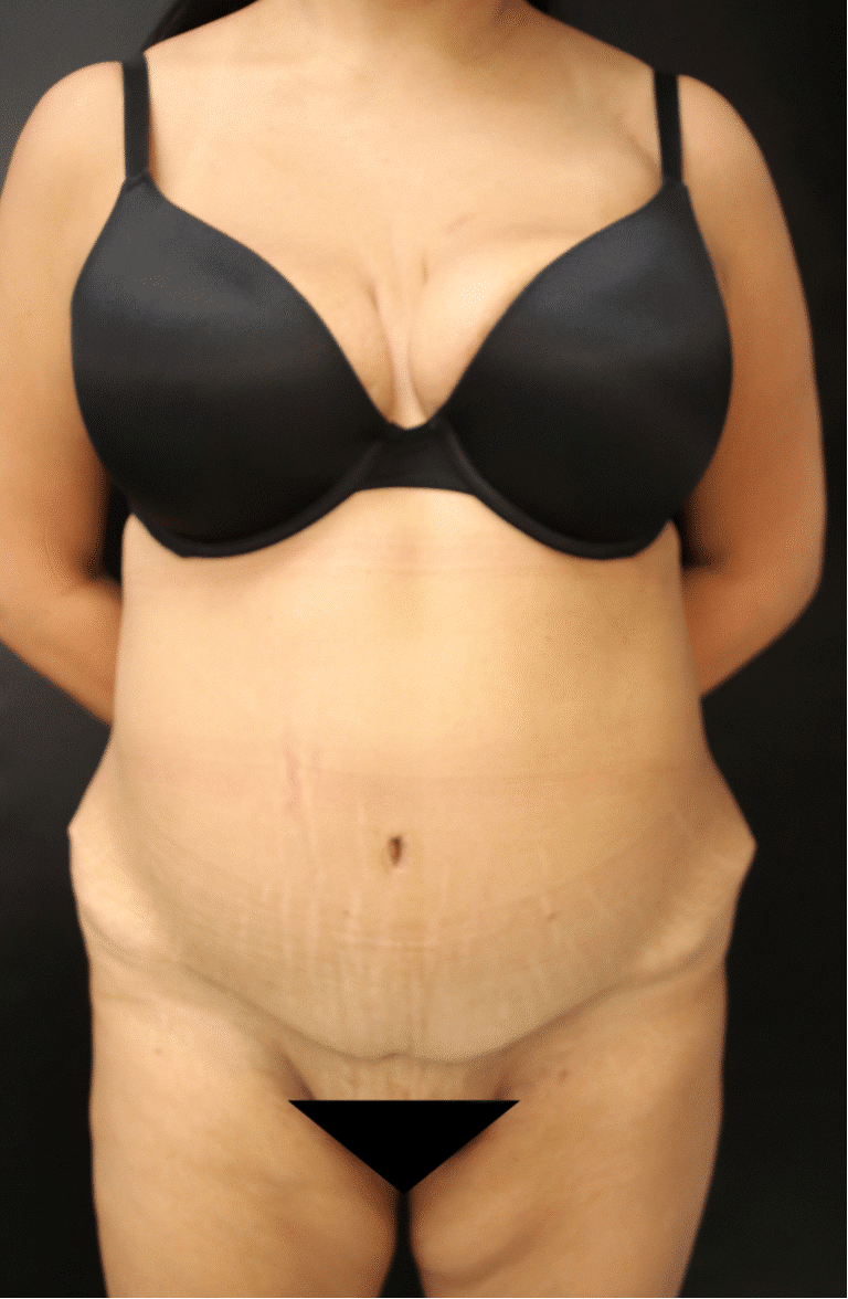 After Image: Abdominoplasty - front