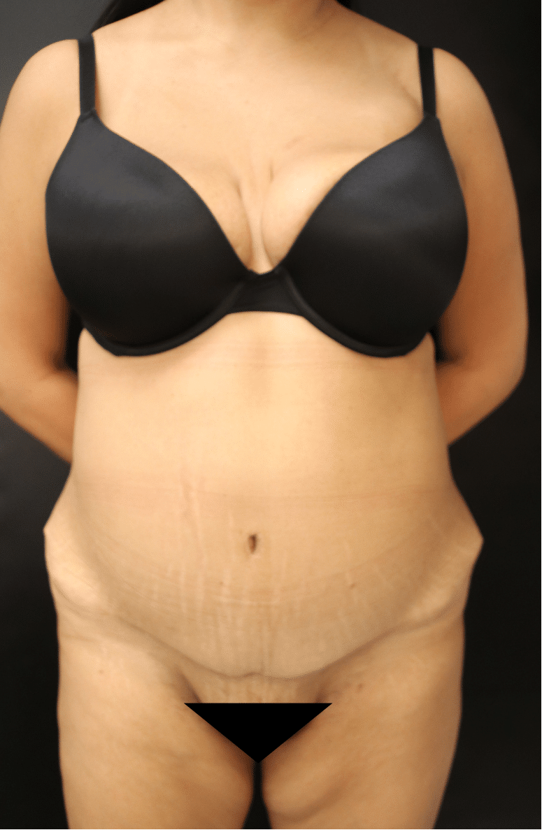 After Image: Abdominoplasty - front