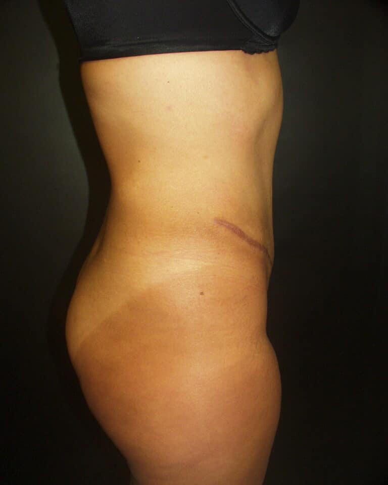 After Image: Abdominoplasty - right-side