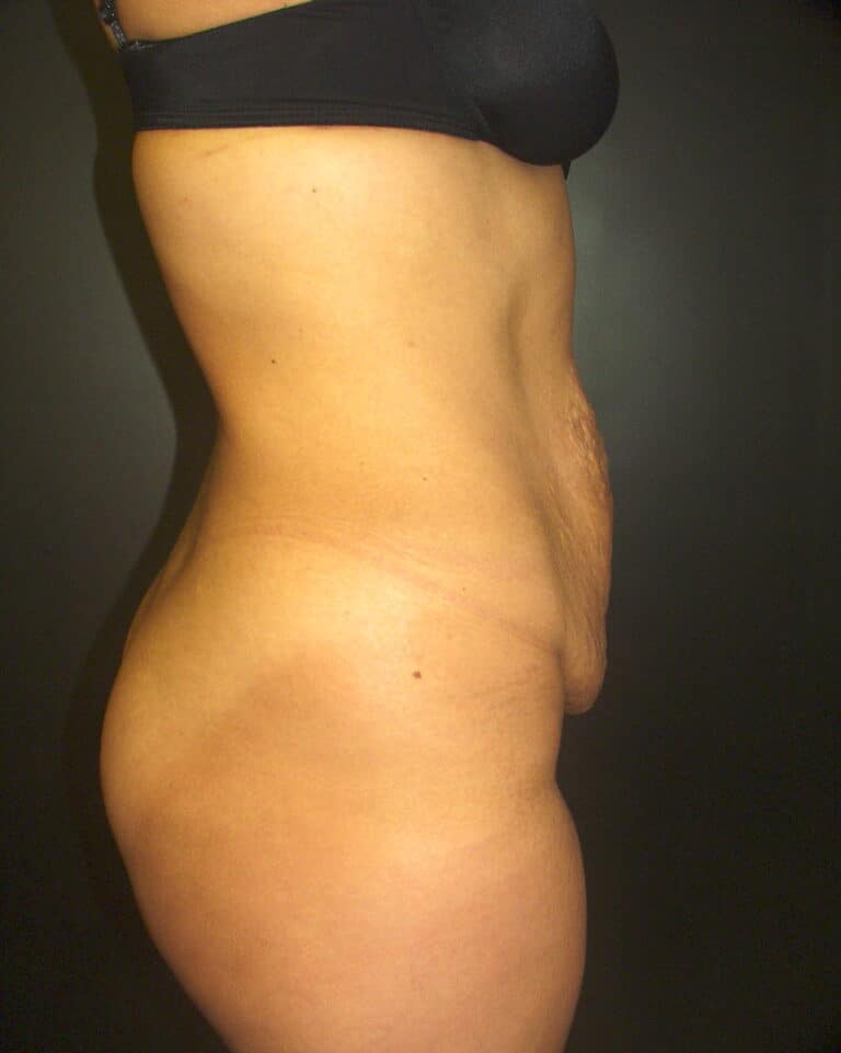 Before Image: Abdominoplasty - right-side