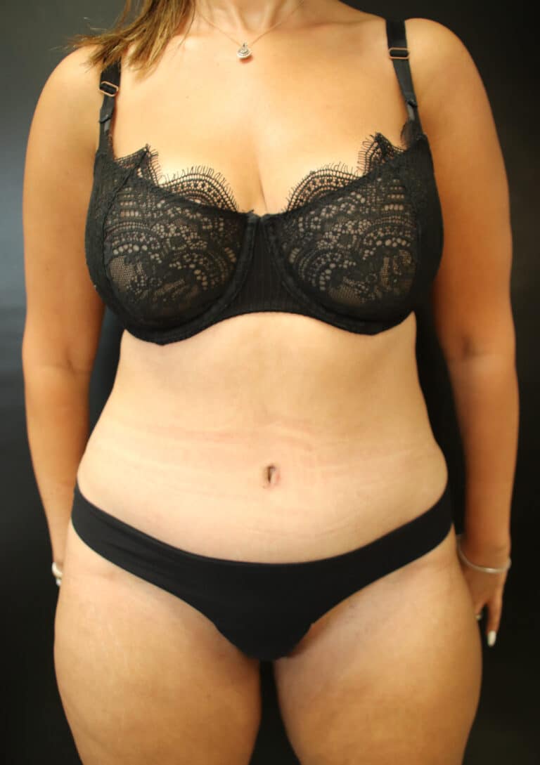 After Image: Abdominoplasty - front