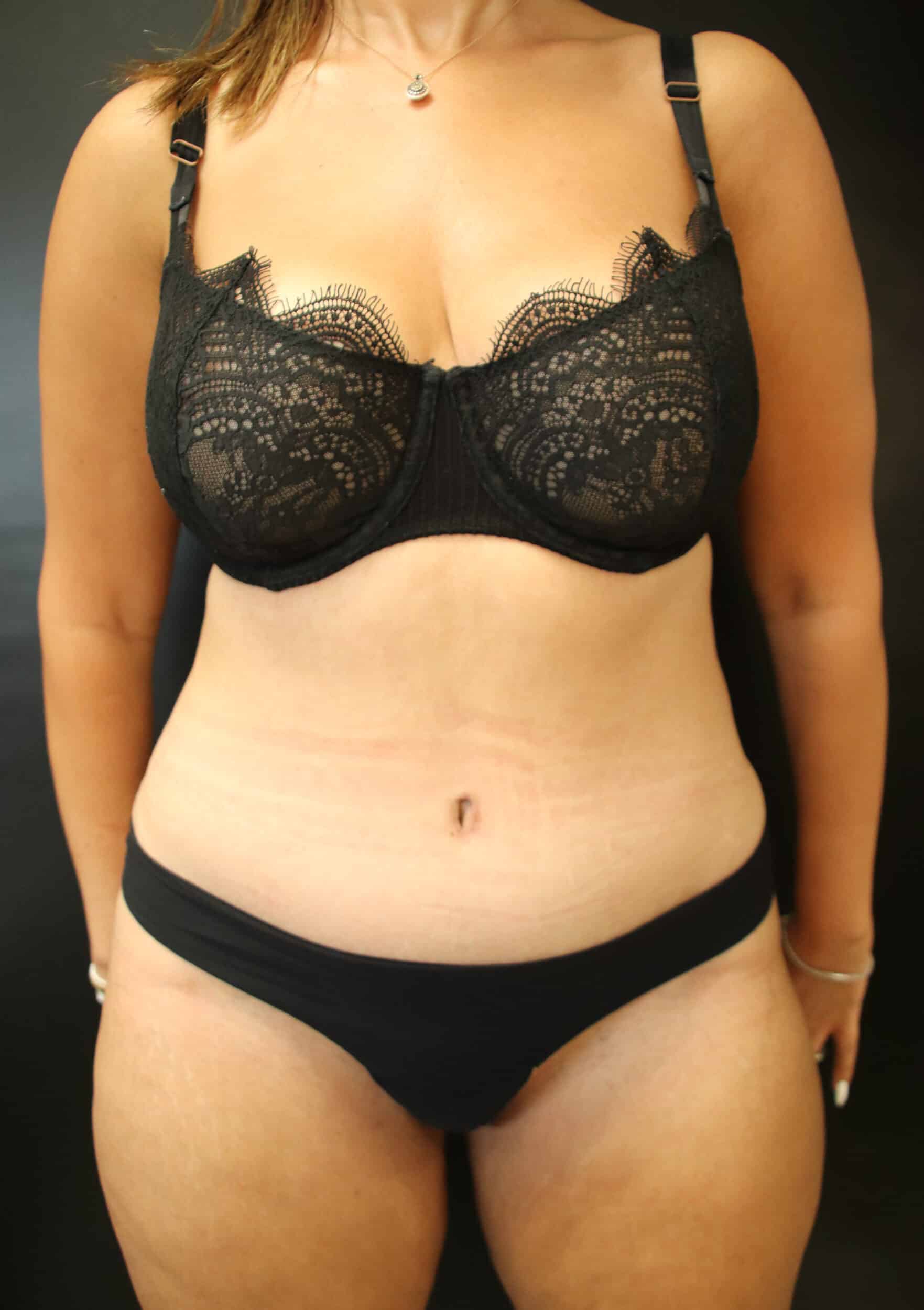 After Image: Abdominoplasty - front