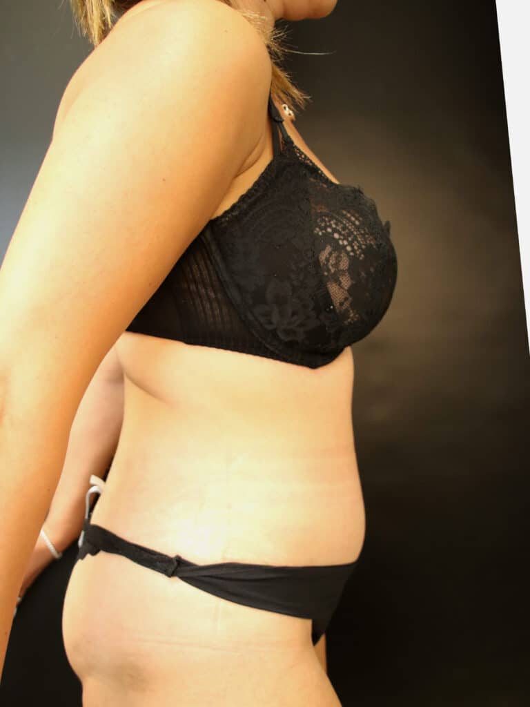 After Image: Abdominoplasty - right-side