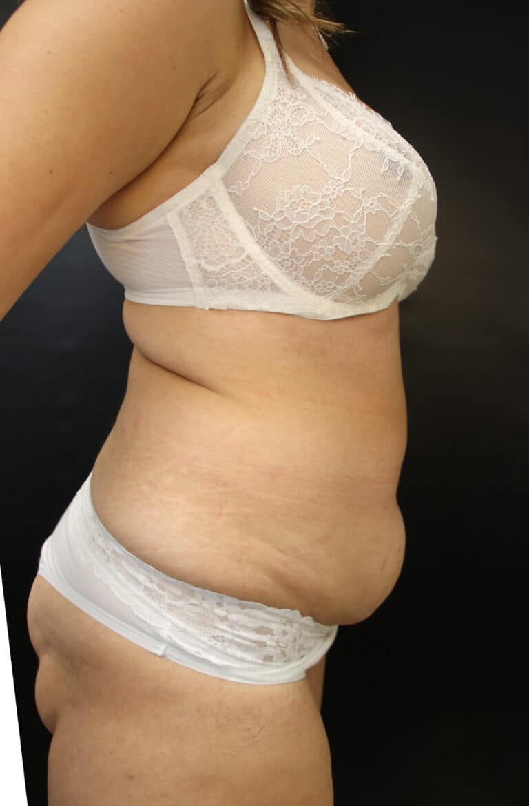 Before Image: Abdominoplasty - right-side