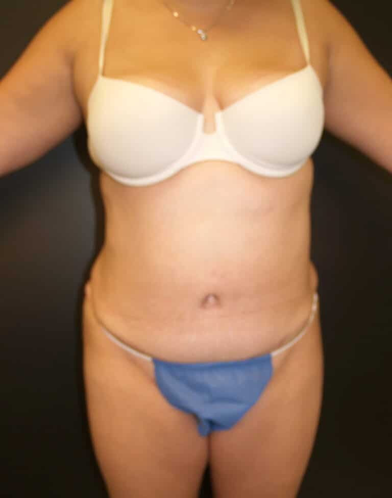 After Image: Abdominoplasty - front