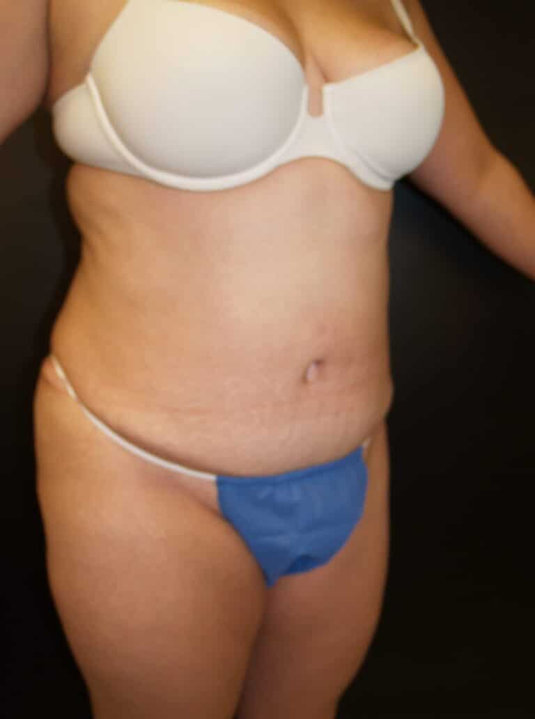 After Image: Abdominoplasty - right-front-oblique