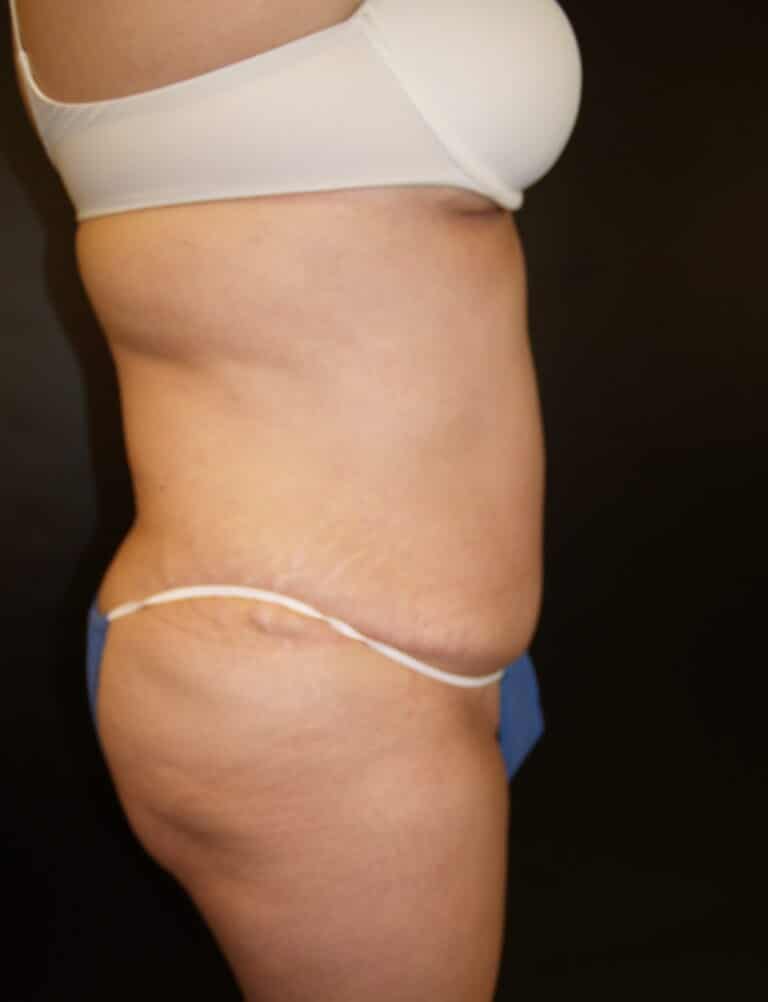 After Image: Abdominoplasty - right-side