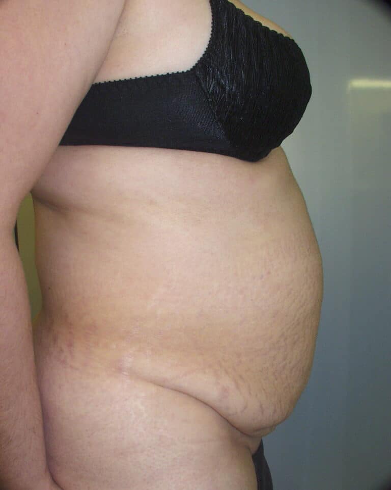 Before Image: Abdominoplasty - right-side