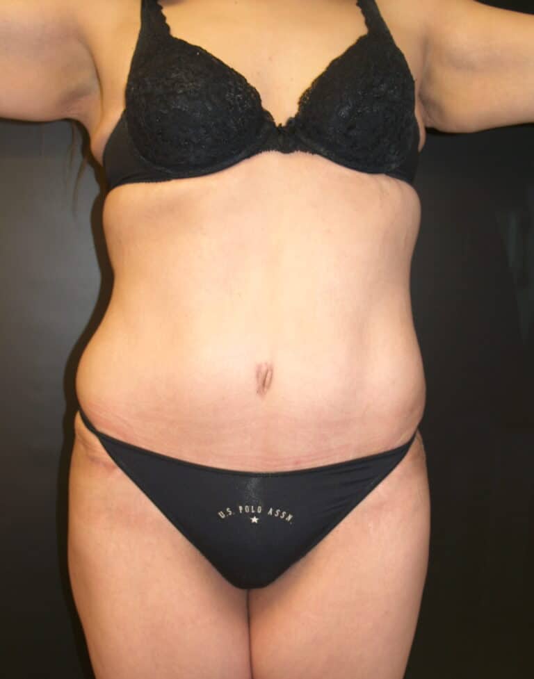 After Image: Abdominoplasty - front