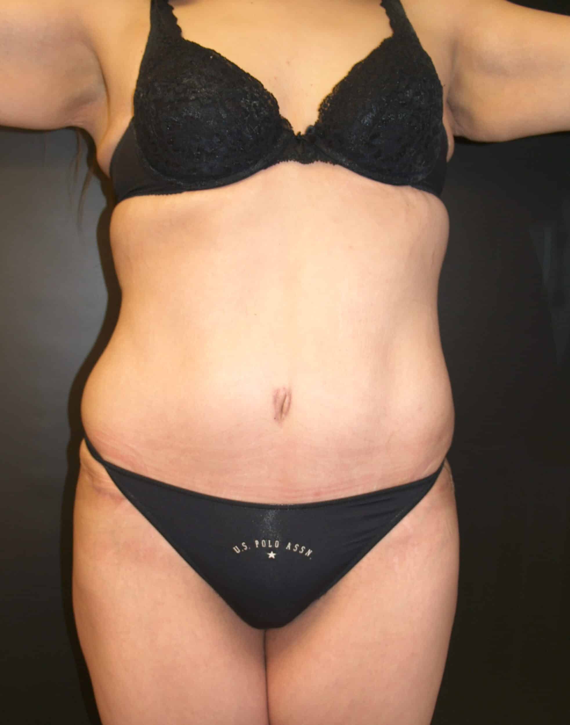 After Image: Abdominoplasty - front