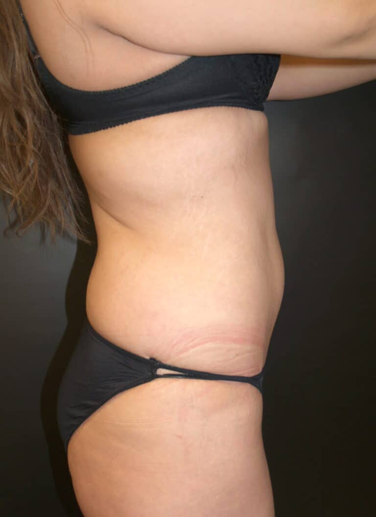 After Image: Abdominoplasty - right-side