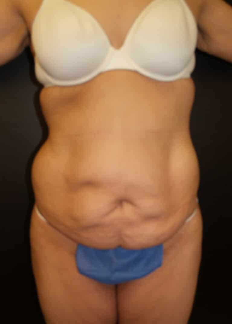 Before Image: Abdominoplasty - front
