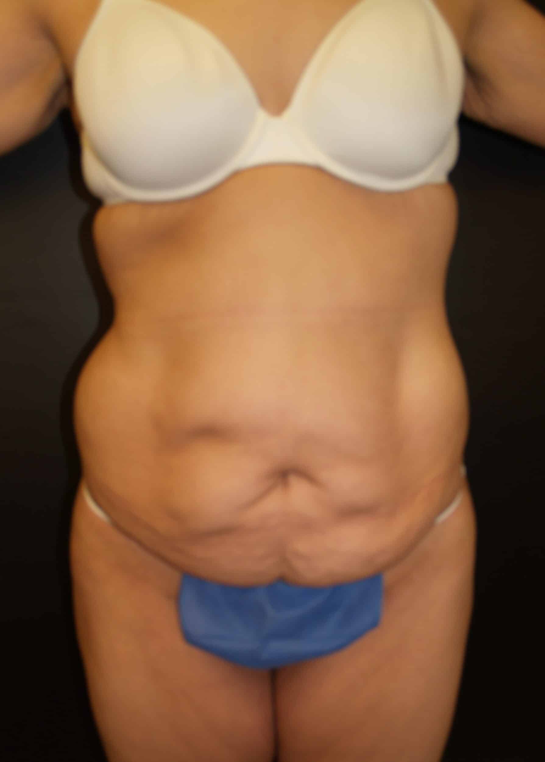 Before Image: Abdominoplasty - front