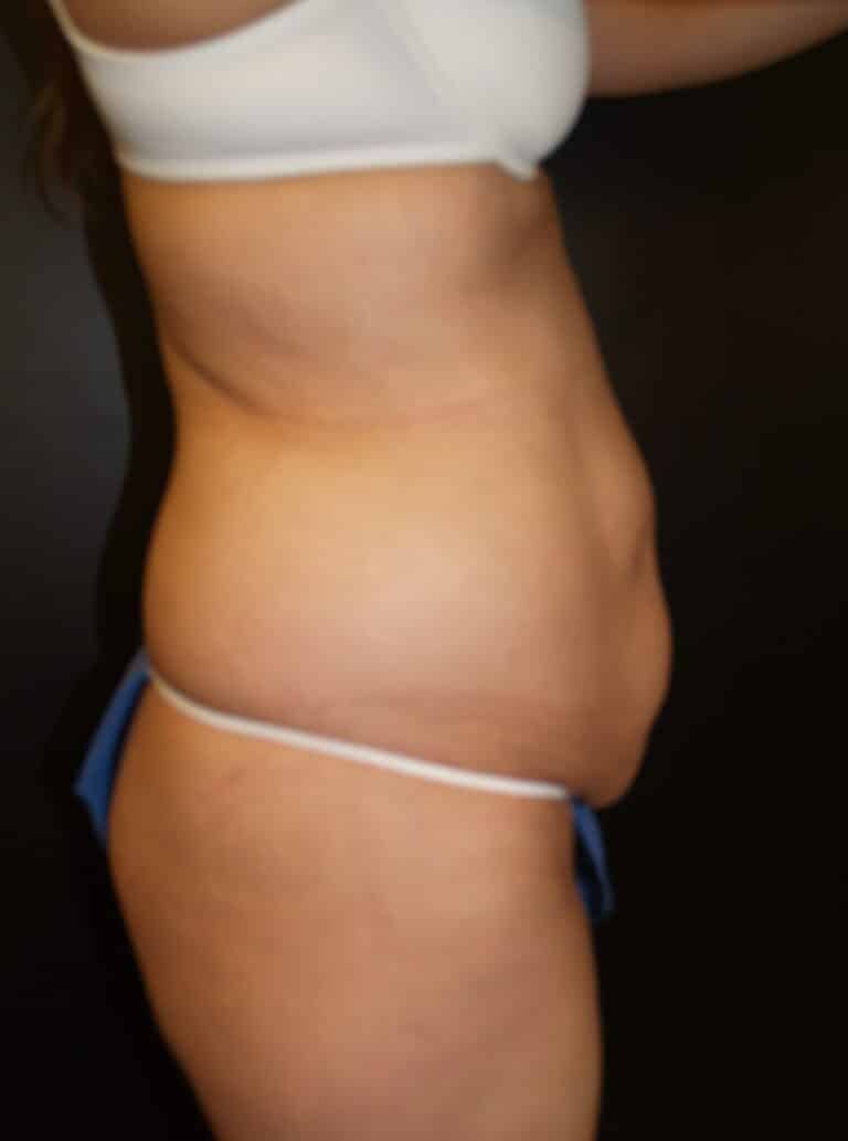 Before Image: Abdominoplasty - right-side