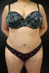 After Image: Abdominoplasty