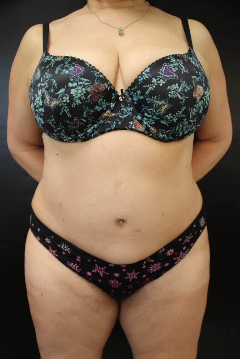 After Image: Abdominoplasty - front