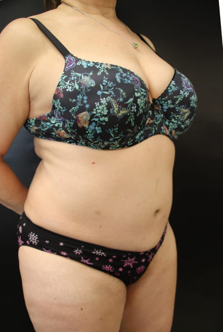 After Image: Abdominoplasty - right-front-oblique