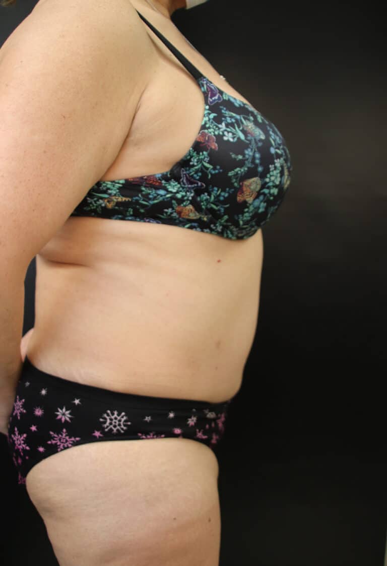 After Image: Abdominoplasty - right-side